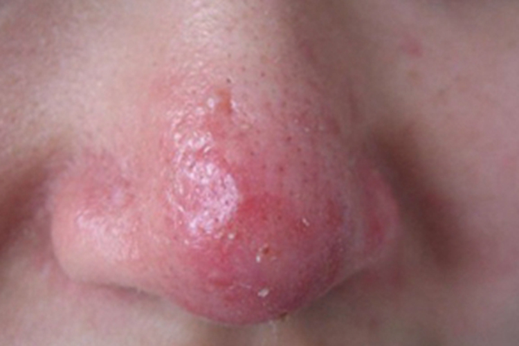 丘疹脓疱型玫瑰痤疮鼻尖丘疹图 丘疹脓疱型玫瑰痤疮鼻尖丘疹图