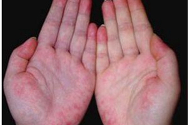 系统性红斑狼疮手掌红斑图