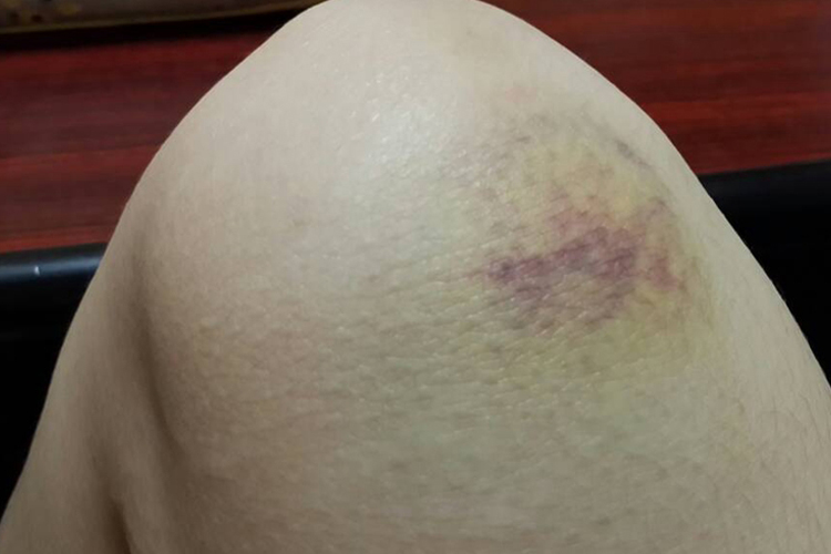 有表皮皮肤青紫图