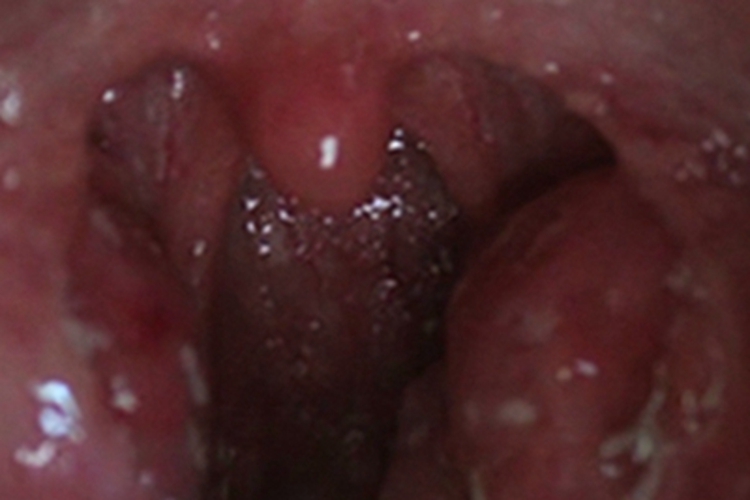 急性扁桃体炎扁桃体又红又肿图