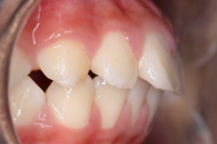 轻微上颌前突图