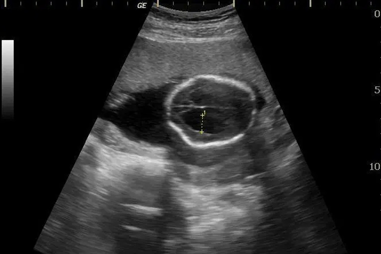 侧脑室增宽超声图