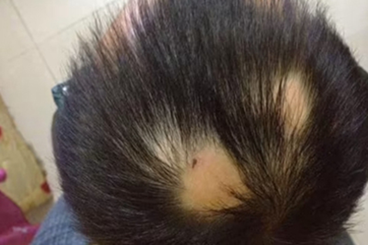 油风脱发头顶不长头发图 油风脱发头顶不长头发图