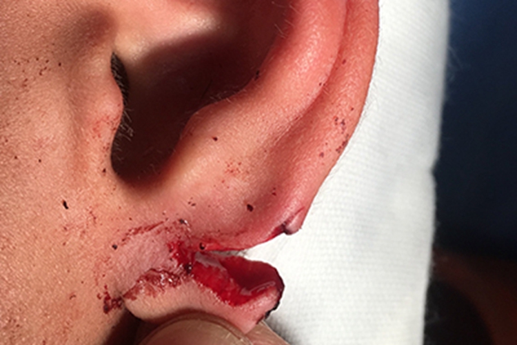 耳廓撕裂伤裂口图