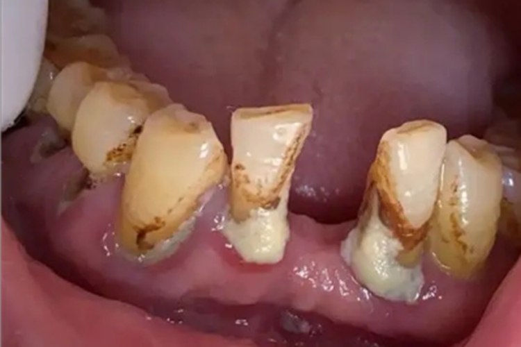 急性坏死性龈口炎萎缩图 急性坏死性龈口炎萎缩图