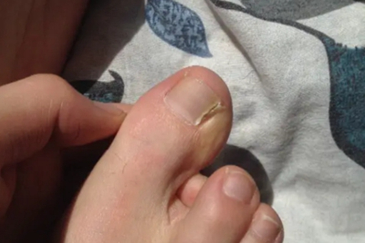 甲纵裂右脚大脚趾边上裂了图 甲纵裂右脚大脚趾边上裂了图