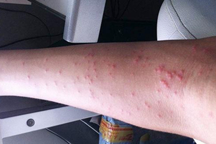 持久隆起性红斑胳膊症状图