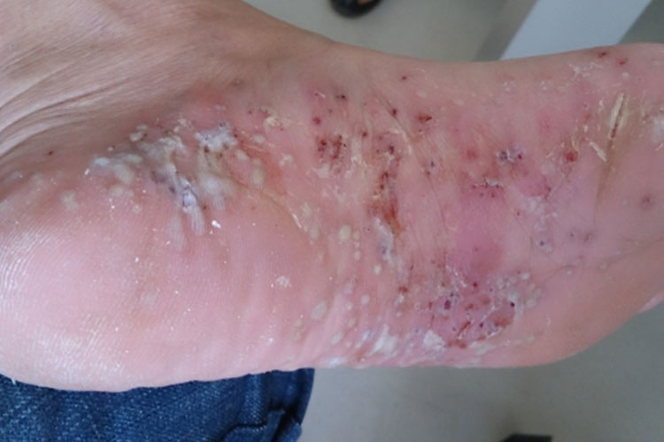 脚底掌跖脓疱病图