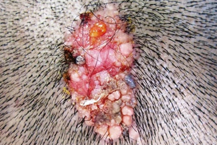 乳头状汗管囊腺瘤头皮肿块图 乳头状汗管囊腺瘤头皮肿块图