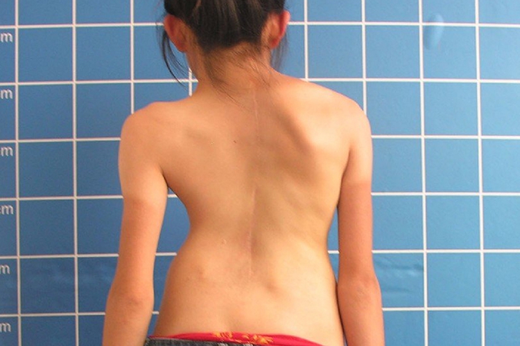 女孩脊柱侧弯变形图