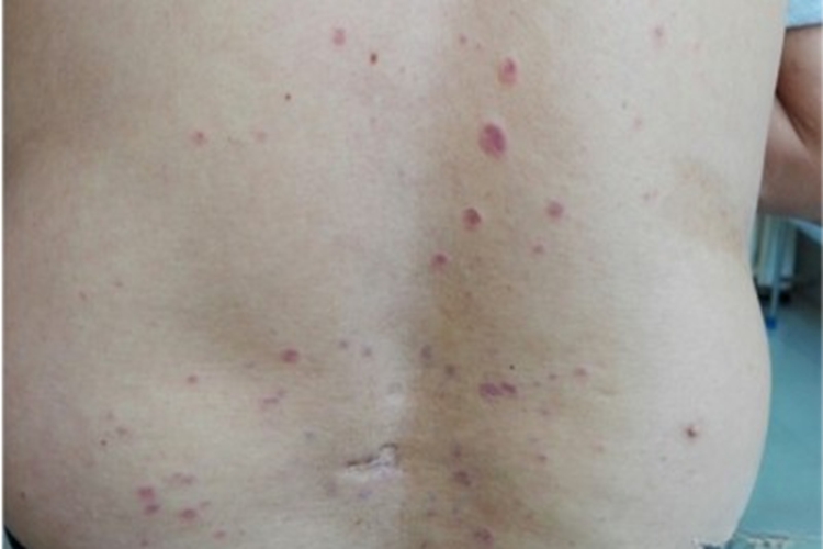 恶性萎缩性丘疹病红斑图