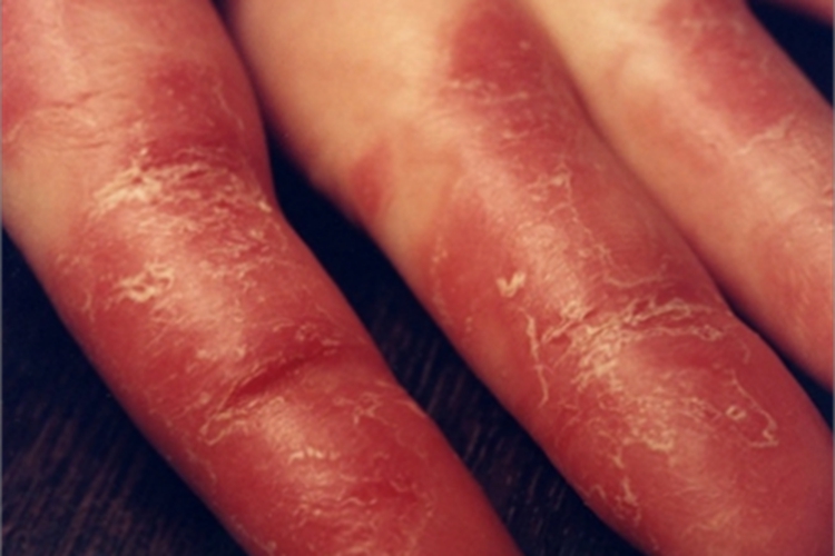 艾滋病非感染性皮肤损害手指裂纹图 艾滋病非感染性皮肤损害手指裂纹图