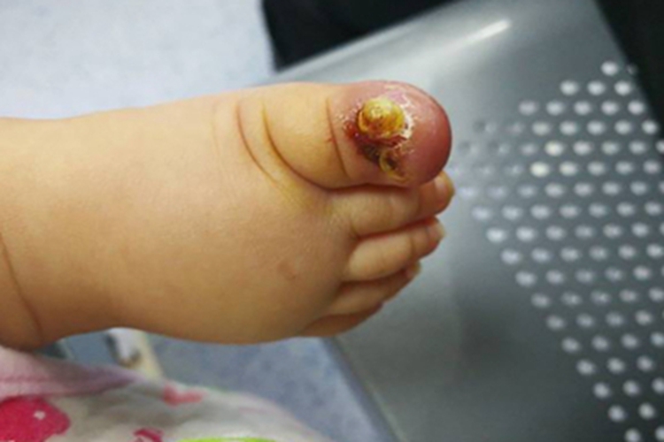 锌缺乏症趾甲甲沟红肿图