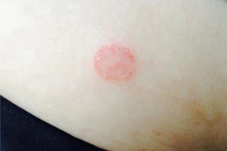 钱币状湿疹腹部症状图