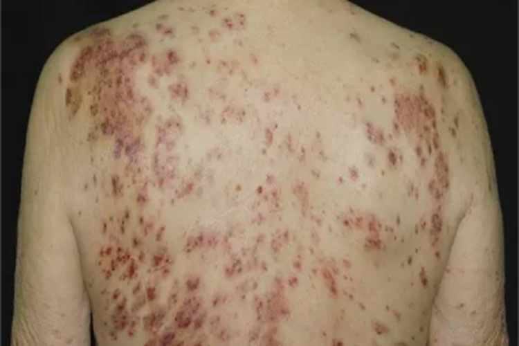 皮肤白血病出现紫斑图