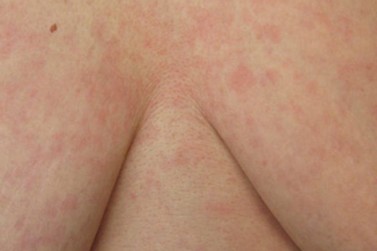 成人Still病胸部症状图 成人Still病胸部症状图