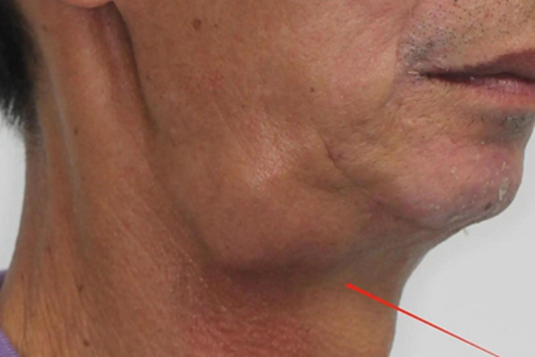 鳃裂囊肿症状图