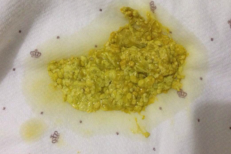 豆渣样大便图