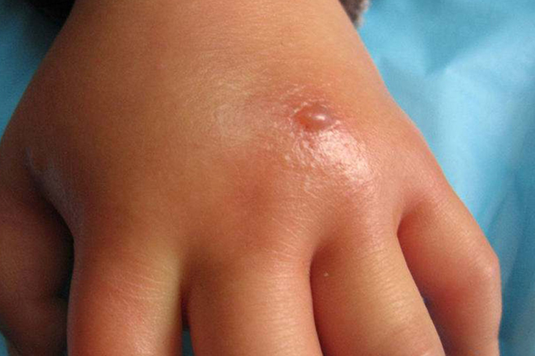 臭虫叮咬水疱图