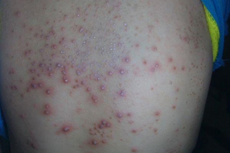 铜绿假单胞菌毛囊炎背部脓包图 铜绿假单胞菌毛囊炎背部脓包图