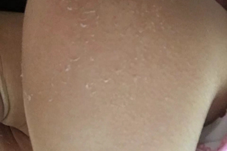 日晒伤肩膀皮肤脱皮图