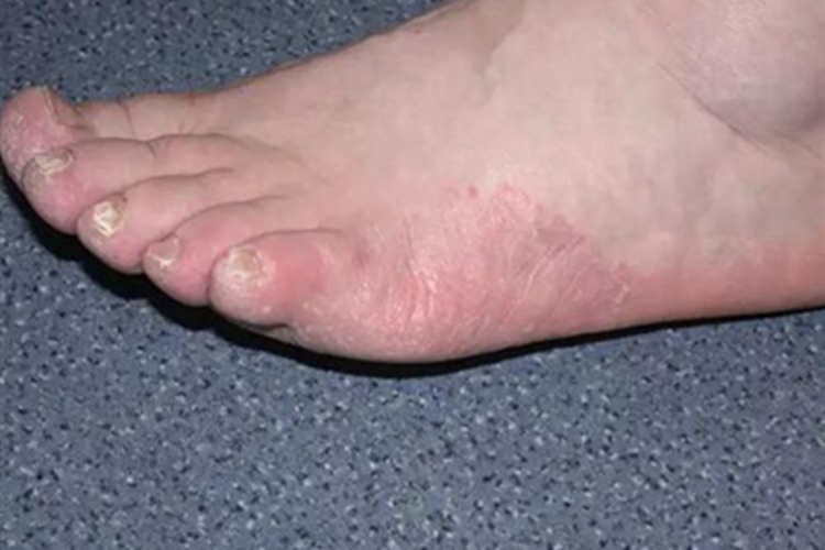 浸渍糜烂型足癣脚部症状图