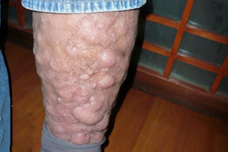 甲状腺功能减退症小腿水肿疙瘩图 甲状腺功能减退症小腿水肿疙瘩图