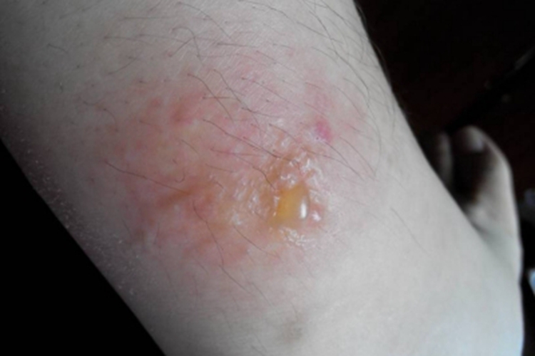 昆虫性皮炎小腿水疱图 昆虫性皮炎小腿水疱图