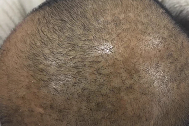 雄激素性脱发头部毛发减少图