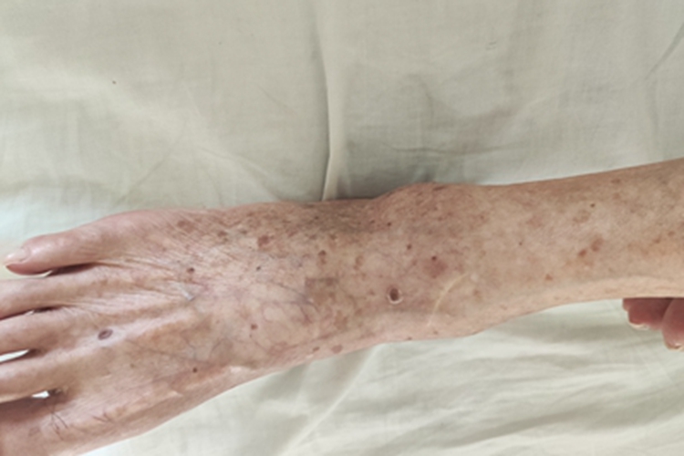 脂溢性角化病脚背症状图 脂溢性角化病脚背症状图