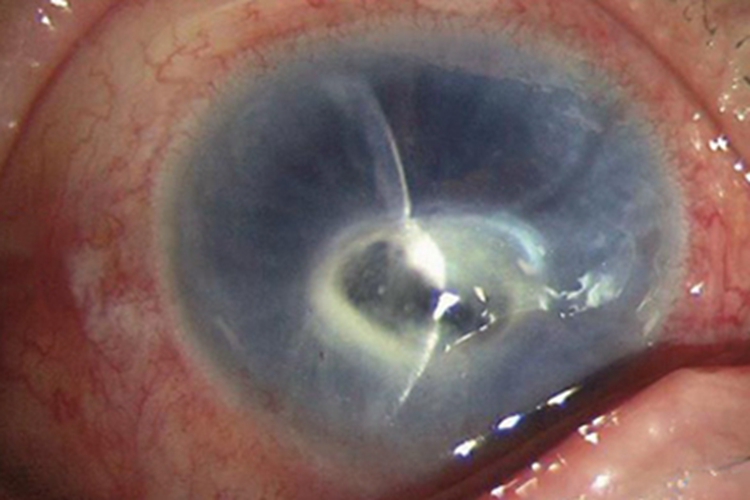 细菌性角膜炎眼球溃疡图