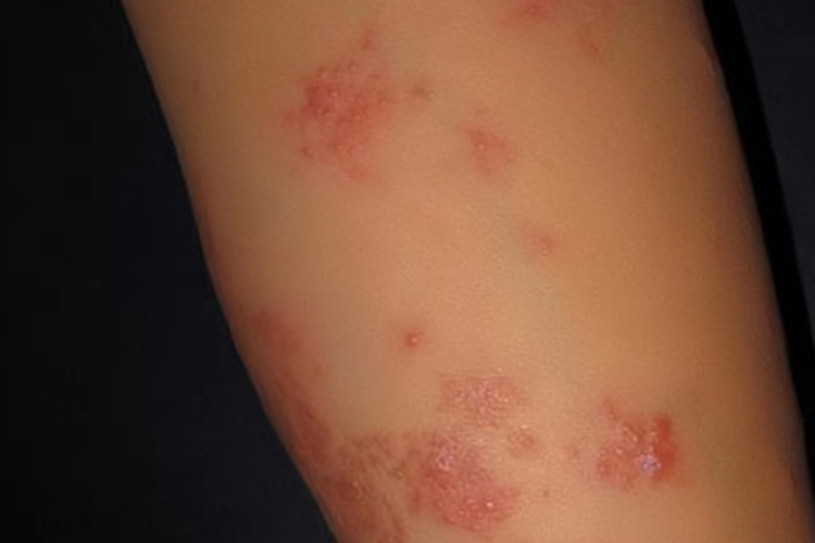 铁过敏丘疱疹图 铁过敏丘疱疹图