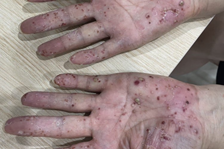 脓疱病手掌血痂图