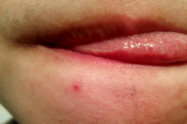 颊白线舌两侧白线图