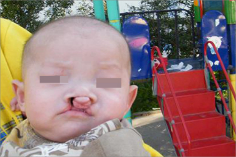 风疹嘴唇肉粒图