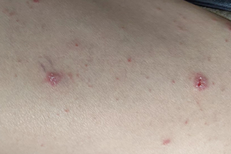 点滴型副银屑病胳膊红斑图