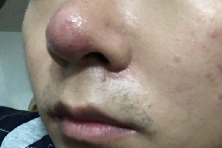鼻赘型酒糟鼻鼻部红肿图