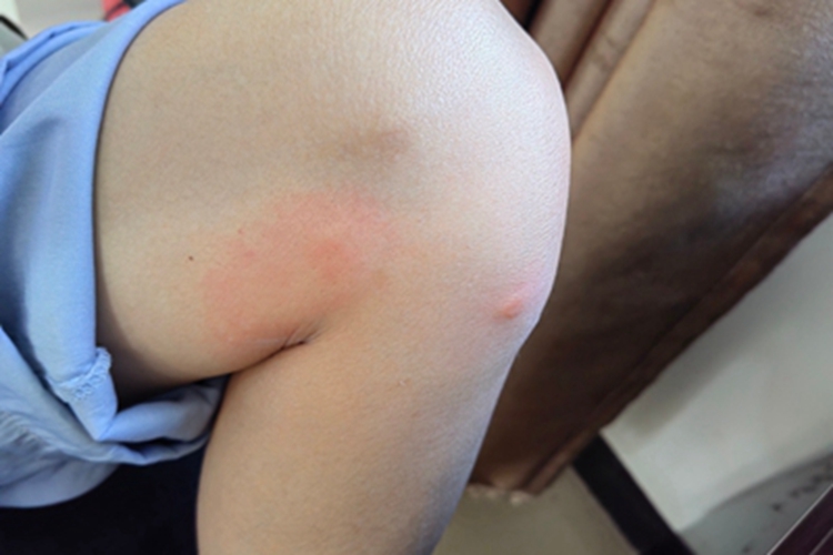 昆虫性皮炎腿部红肿图 昆虫性皮炎腿部红肿图