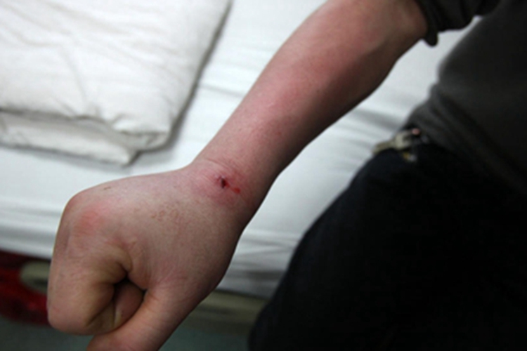 戳伤手腕症状图