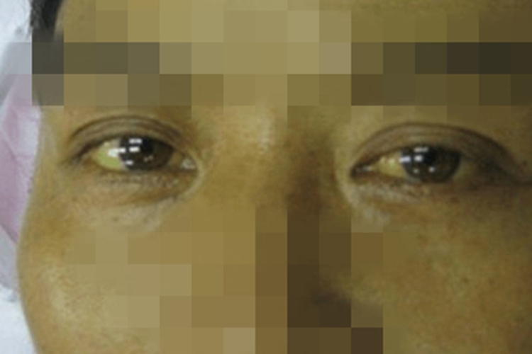 Gilbert综合征发黄图 Gilbert综合征发黄图