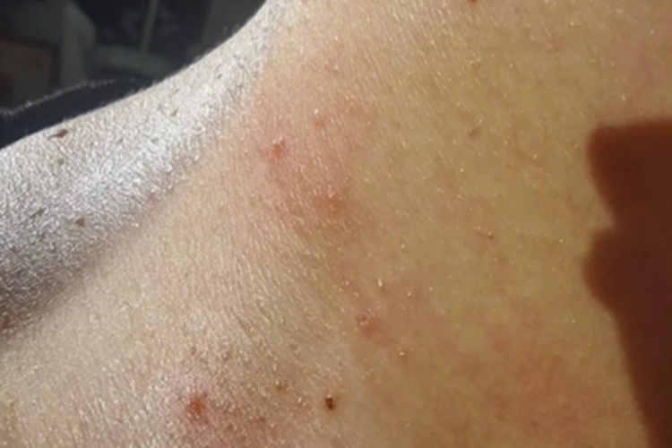 慢性接触性皮炎侧颈症状图