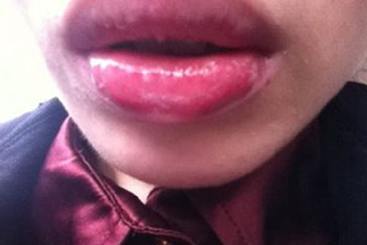 唇肉芽肿图 唇肉芽肿图