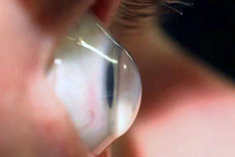 圆锥角膜角膜突出变形图