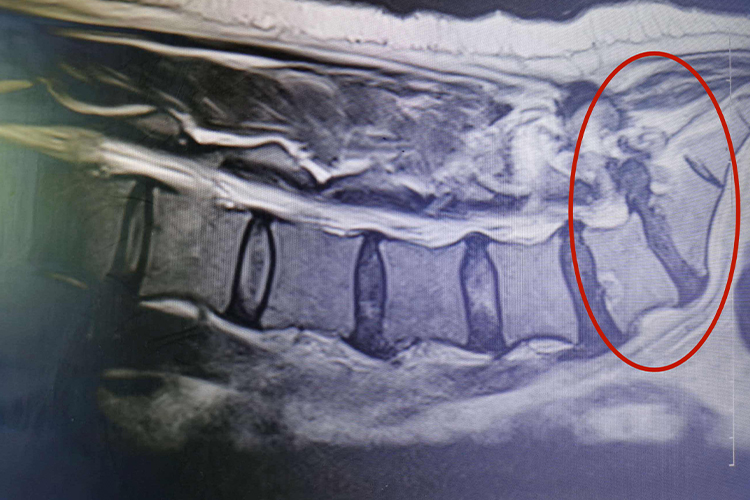 腰5骶1椎间盘突出中央型图