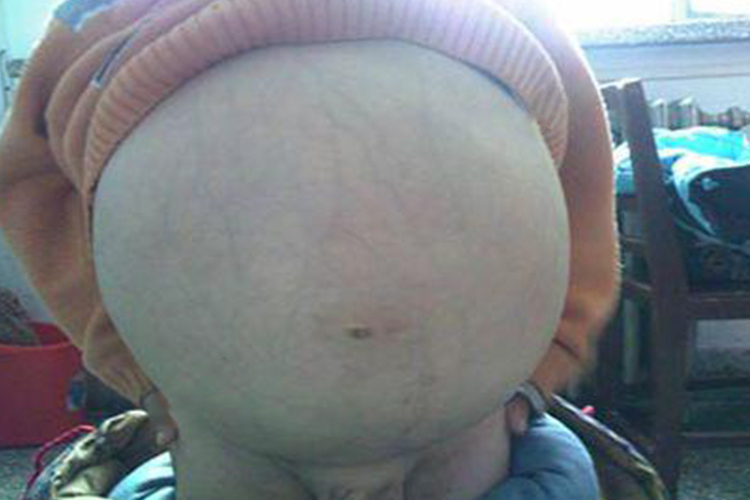 腹壁静脉怒张图 腹壁静脉怒张图