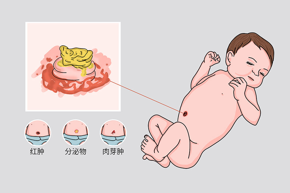 新生儿脐带发炎怎么办图片