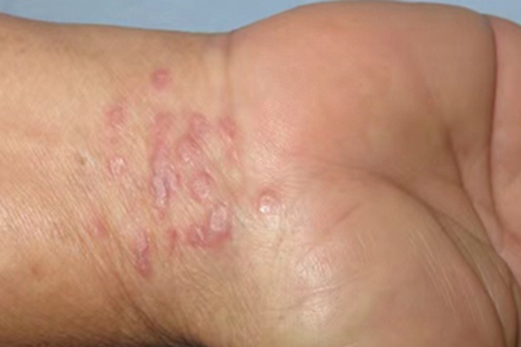 扁平苔藓手腕症状图 扁平苔藓手腕症状图