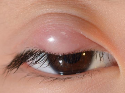 眼睑脓肿的症状和图片