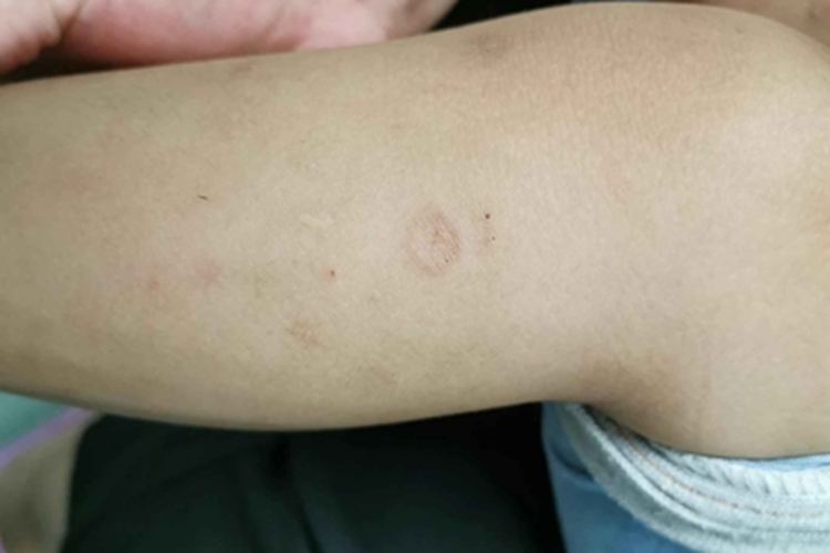 局限型环状肉芽肿小腿长疙瘩图 局限型环状肉芽肿小腿长疙瘩图