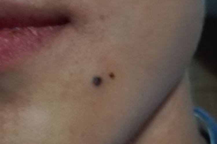 发育不良痣综合征下巴黑痣图 发育不良痣综合征下巴黑痣图
